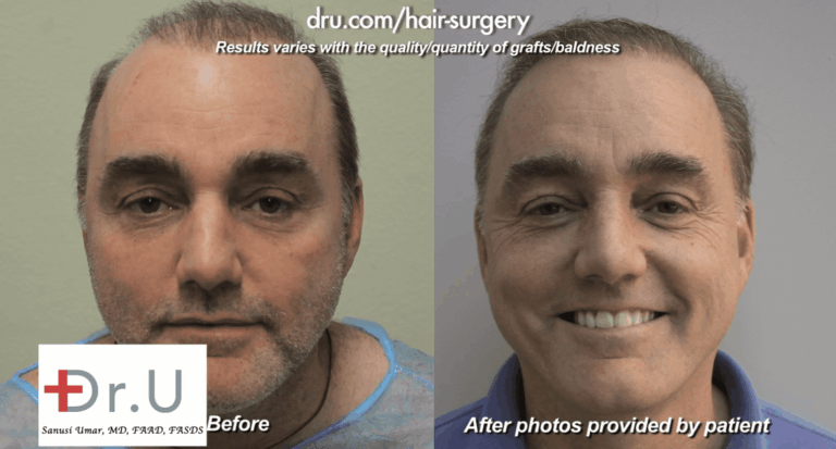 Front facial view of the patient showing the repair of pluggy doll's hair after hair transplant procedures from the 80s left patient with poor growth and cosmetic results *