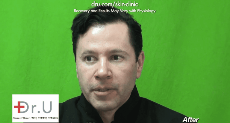 Patient remarks that Belotero filler for crows feet did a great job at filling in the deepening lines around his eyes*