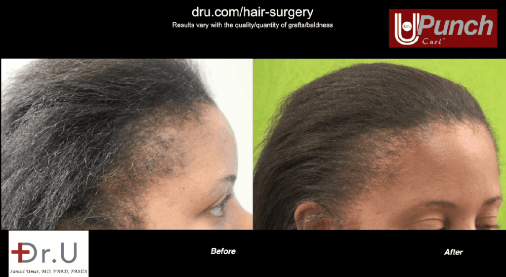 Traction alopecia prevention and treatment: This patient had abused her hair for years with braids, weaves, and tight ponytails. She later underwent the Dr.UGraft procedure to restore her hair. Traction alopecia prevention and treatment: This patient had abused her hair for years with braids, weaves, and tight ponytails. She later underwent the Dr.UGraft procedure to restore her hair.