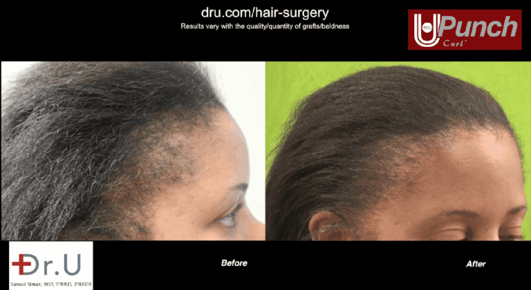 Patient before and after her bald edges treatment performed with the Dr.UPunch Curl