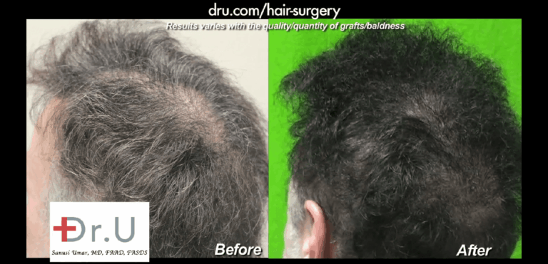 3000 beard hair grafts produced an incredible slot deformity repair outcome