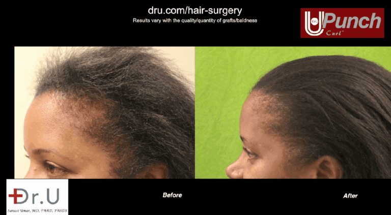 Image of black female hair transplant before and after her edges restoration surgery with the Dr.UPunch Curl.