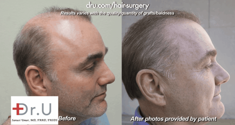 Right profile view comparing what the patient looked like before and after his Dr.UGraft procedure which provided drastic correction for bad hair transplant results
