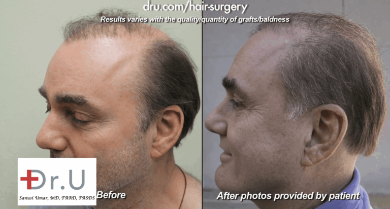 Left profile view showing how the patient's Dr.UGraft surgery was able to fix the problem of o growth after hair transplant