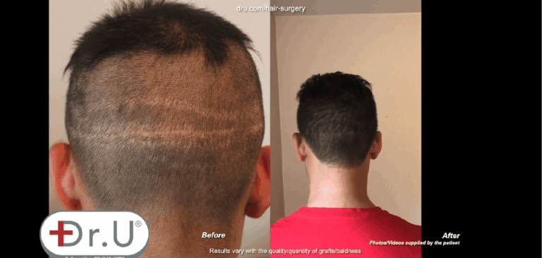 Venice Beach patient before and after his Dr.UGraft™ hair transplant scar cover up. He is now able to wear the clean, short hairstyle that flatters his appearance 