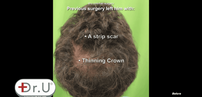Before his Dr.UGraft™ patient's crown area shows transplanted hair not growing
