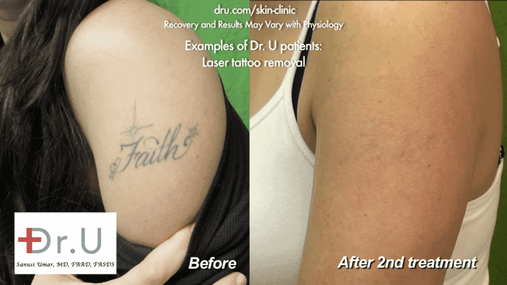 This before and after image shows the results of two sessions of tattoo removal with laser. A faint outline can still be seen, which was addressed in a follow-up session