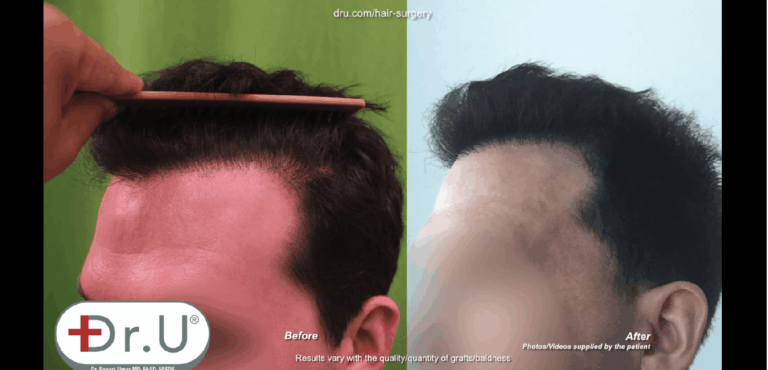 Patient no longer has plugginess along his hairline thanks to Dr. Umar