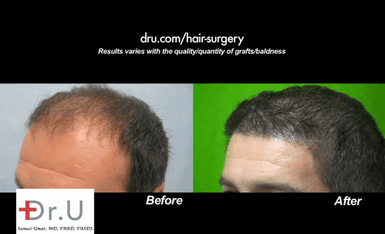 Dr. Umar was able to correct this patient's depleted hairline and temples