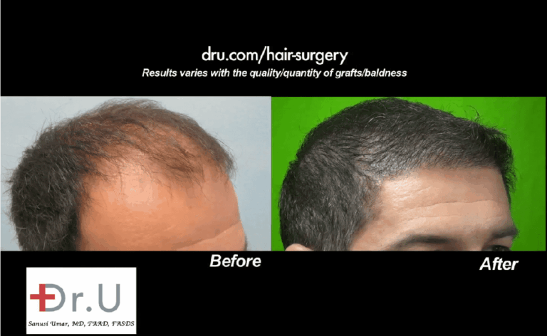Patient's hairline and temples shown from the right side