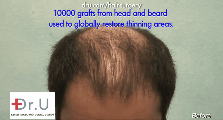 Top part of scalp shows severe thinning instead of complete hair loss