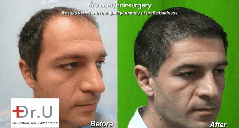 The addition of beard hair to this patient's donor pool helped him regain a younger looking appearance 