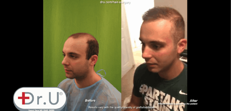 Patient defies the minimum age for a hair transplant thanks to his Dr.UGraft ™ body hair to head surgery
