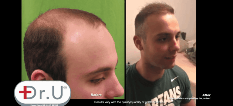 Profile view of Manhattan Beach patient who achieved the results he wanted from his early 20's hair transplant