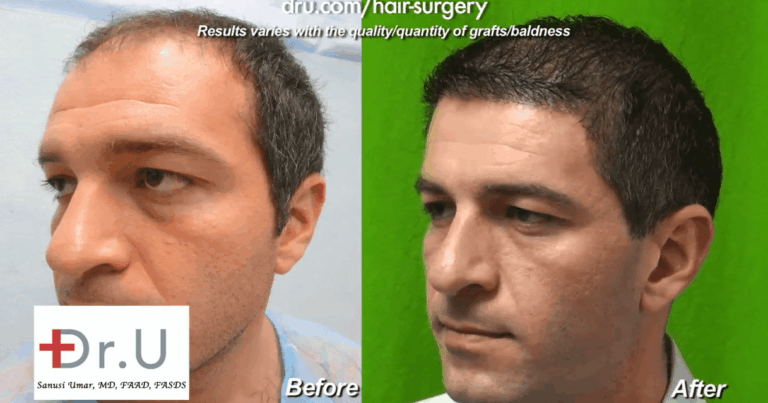 With a 10,000 grafts hair transplant, this patient achieved amazing coverage and a youthful low hairline