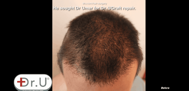 Patient hope to undo hair transplant results on the top of his head 