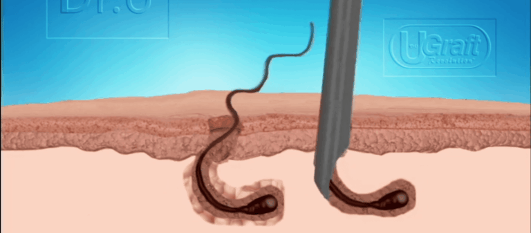The Dr. UPunch Curl is an excellent choice for black females interested in undergoing edges restoration surgery