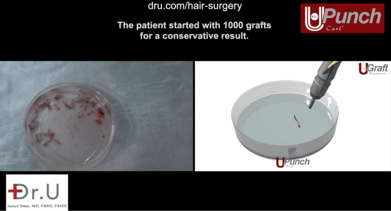 The Dr. UPunch Curl can be attached to a fluid irrigation system to produce healthier, hydrated grafts. This increases the likelihood of traction alopecia regrowth following a Dr.UGraft restoration procedure. 