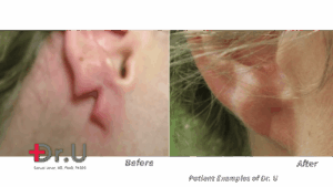 After seeing a rip or tear, many wonder "Will a split earlobe repair itself?". The answer, Dr. Umar explains, is generally "no".*