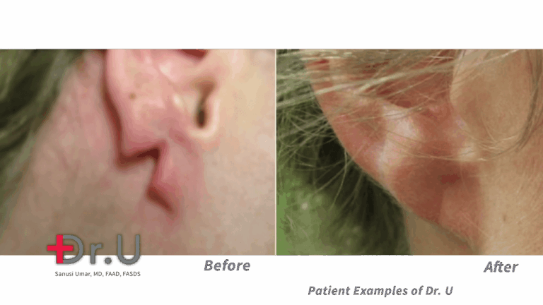 After seeing a rip or tear, many wonder "Will a split earlobe repair itself?". The answer, Dr. Umar explains, is generally "no".