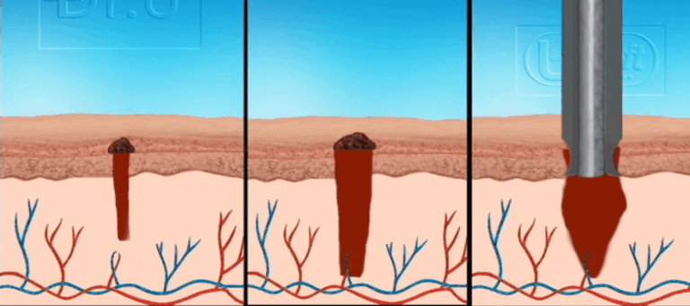 The Dr.UGraft rotary punch is able to create a more diamond shaped wound cavity which leaves behind a more flat skin surface and better wound healing results compared to conventional Follicular Unit Extraction punches. 