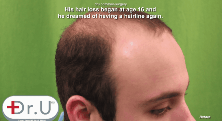 Profile view showing empty temples before his Dr.UGraft™early 20's hair transplant procedure