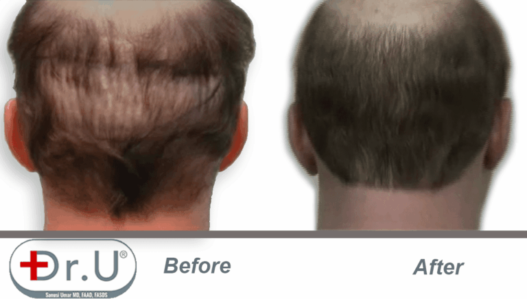 Before and after view of scalp donor area which was repaired with body hair grafts. Filling in this area was one of the goals of the patient's hair transplant repair for hairpiece integration.