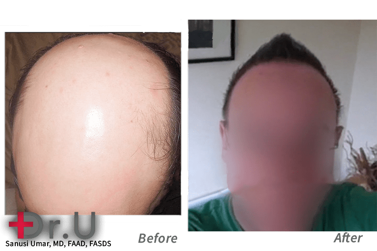 The primary FUE hair transplant donor area used on this Norwood 7 patient was the beard region which helped him conquer his severe baldness.