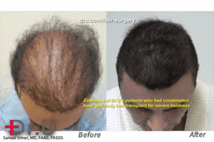 This patient lacked sufficient head donor grafts for sufficient coverage from a hair transplant. This is known as hair transplant donor overharvesting. Dr. Umar was able to harvest additional grafts from body areas in order to meet this patient's higher graft count.