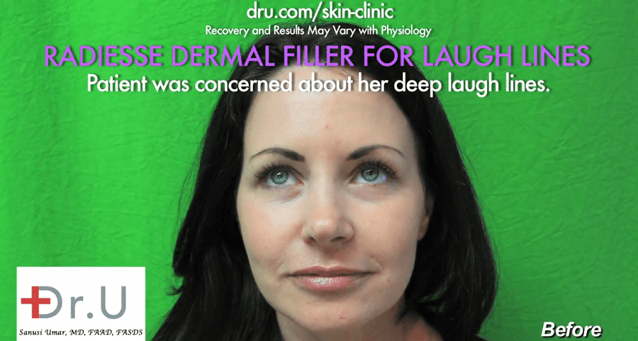 Patient before her treatment with Radiesse, hoping to benefit from the right nasolabial fold filler Patient before her treatment with Radiesse, hoping to benefit from the right nasolabial fold filler
