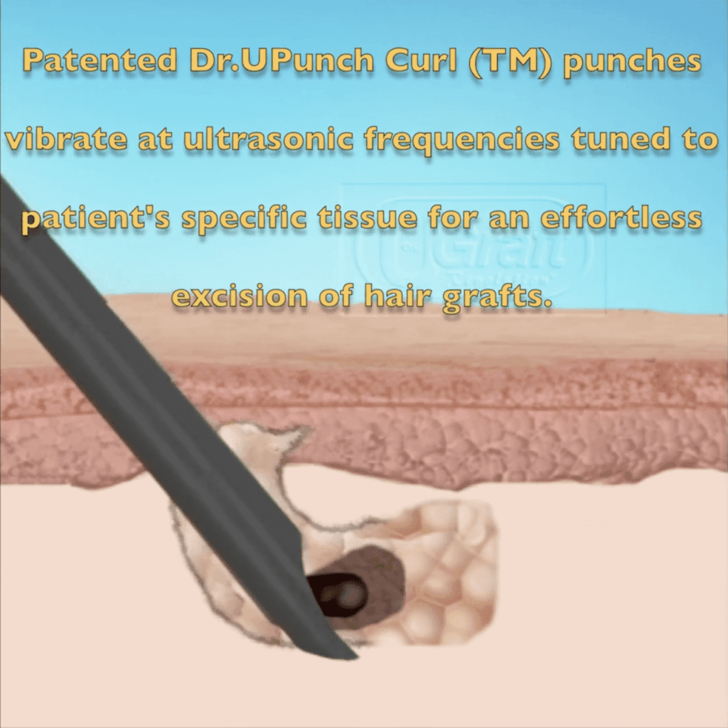 Dr. Umar pioneered the ultrasonic hair transplant technology tunes frequencies according to a patient's specific tissue profile. This assists in the ease of extraction.*