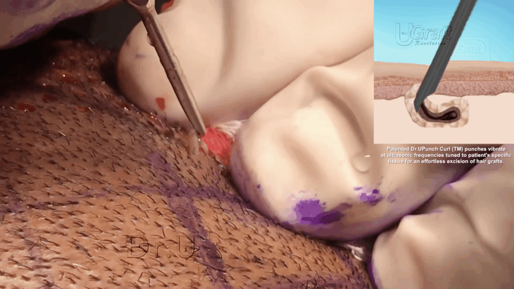 The apparent ease of extraction with Dr. UGraft™'s sonic hair transplant tools can be seen in the image above, in which a freshly scored graft is popping out of the surrounding tissue.*