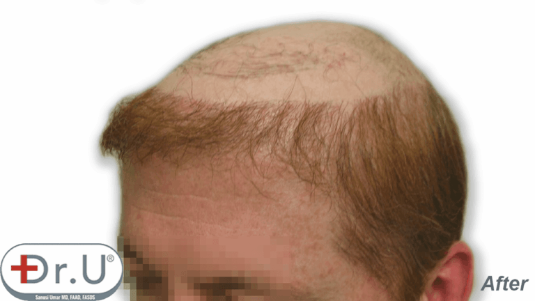 Many men are interested in a combination of hair transplant and hairpiece to achieve the coverage they want. This photo shows a three-quarters facial view showing the patient's hairline temples created for his hairpiece.