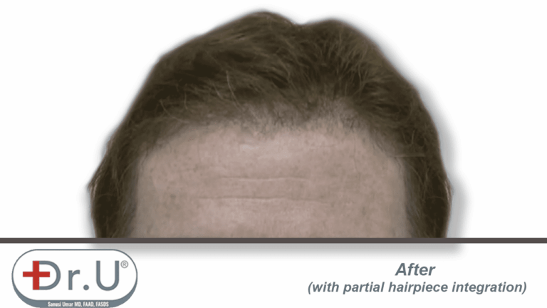 Final results showing patient's partial hairpiece integration with the hairline and temples created during his Dr.UGraft procedure.
