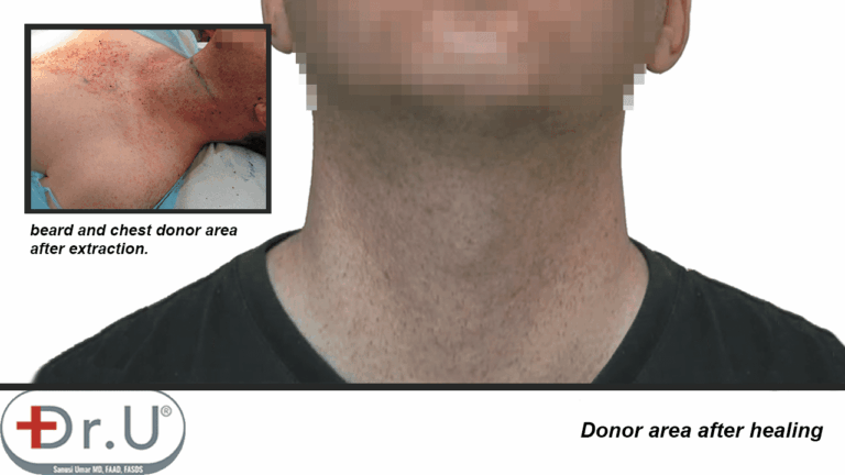 Beard region on patient's face and neck healed without noticeable signs of redness or scarring, following his hair transplant and hairpiece combination surgery using Dr.UGraft technology.