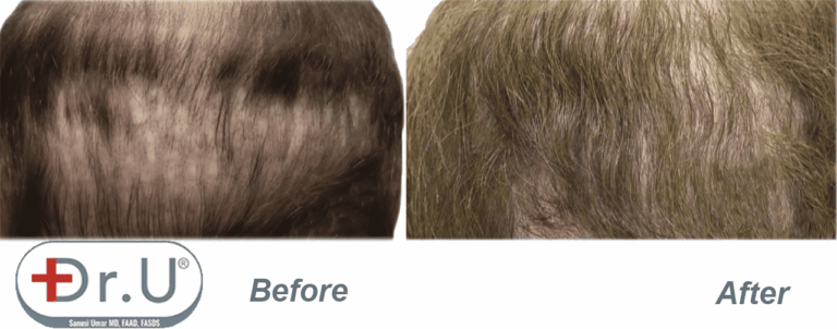 Close up view showing final results of repair where body hair grafts were used to fill in the patient's depleted donor region on his scalp.