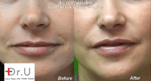 This Manhattan Beach patient approached Dr. U for a smile lines filler treatment.