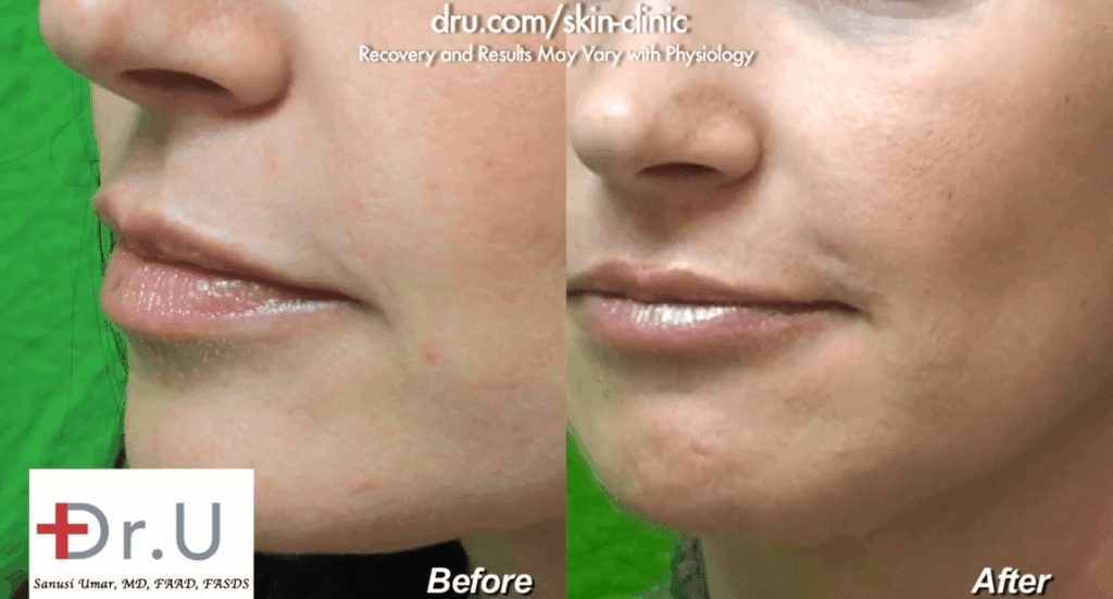 Close-up, side view of patient's treatment using Radiesse for nasolabial folds before and after Close-up, side view of patient's treatment using Radiesse for nasolabial folds before and after