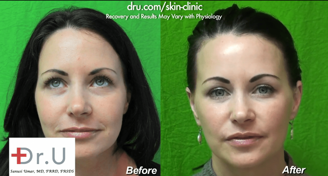 Patient is a firm believer that Radiesse is the best filler for nasolabial folds Patient is a firm believer that Radiesse is the best filler for nasolabial folds