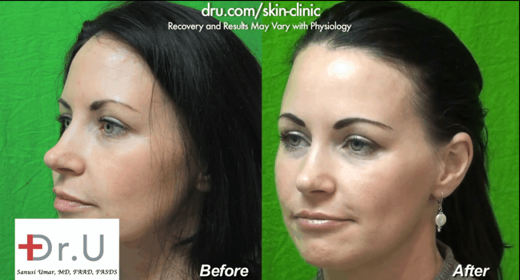 The simple use of a nasolabial fold filler can greatly improve the youthfulness of a person's face The simple use of a nasolabial fold filler can greatly improve the youthfulness of a person's face