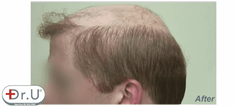 Final results of hairline and temples for this Redondo Beach patient's hairpiece integration surgery