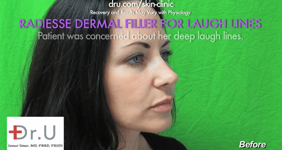 Side view of patient showing the depleted facial volume in her lower face that required treatment with a smile lines filler Side view of patient showing the depleted facial volume in her lower face that required treatment with a smile lines filler