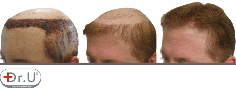 Progression of results for hair transplant and hair piece combination. On the left is the recipient area directly after hair transplant. In the middle is the full result of the hairline and temple reconstruction. On the right is the full result of the procedure, with the patient's hairpiece of choice.