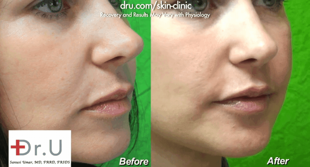 Radiesse as a smile lines filler created the look of more volume in the patient's lower face Radiesse as a smile lines filler created the look of more volume in the patient's lower face