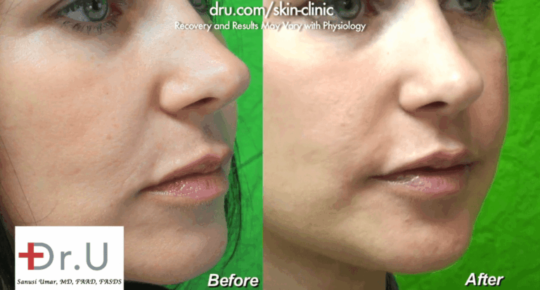 Different types of dermal fillers can be used to fill in laugh lines, also known as nasolabial folds. Radiesse was used for this patient