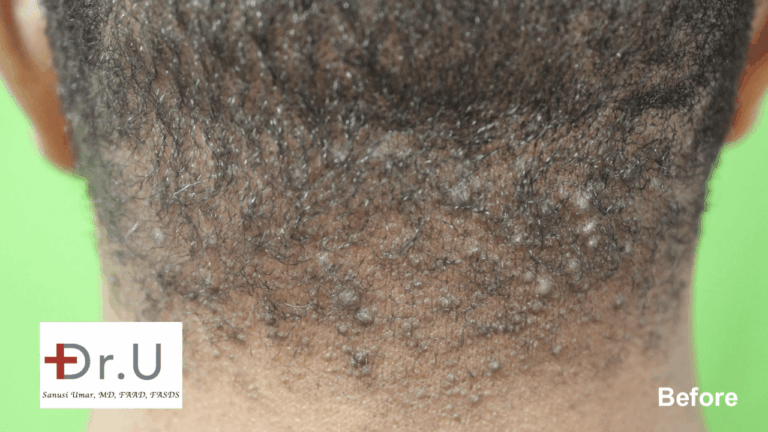 This patient came in to Dr. Umar's Los Angeles AKN Bump Clinic with hard bumps on head scalp.