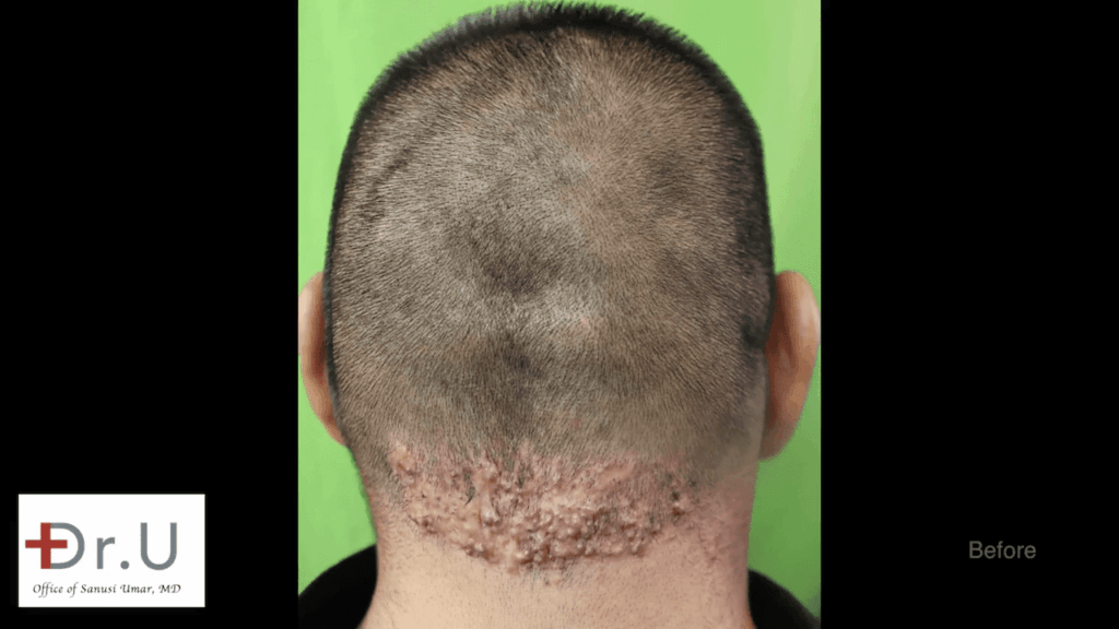 The Walnut Park patient sought a cure for chronic razor bumps behind head after previous treatments at other clinics had failed. The Walnut Park patient sought a cure for chronic razor bumps behind head after previous treatments at other clinics had failed.