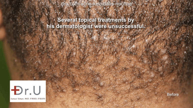 A close-up view of the bumps under hair on the back of the neck. This East Los Angeles patient consulted Dr. U for treatment after various other methods at other clinics had failed.