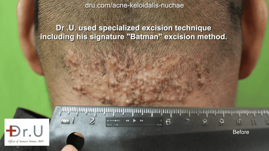 This Walnut Park patient endured symptoms of AKN like a bump on head for years before consulting at the Dr. U AKN Bump Clinic. This Walnut Park patient endured symptoms of AKN like a bump on head for years before consulting at the Dr. U AKN Bump Clinic.