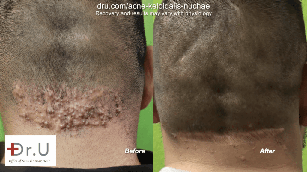 This patient finally found a cure for razor bumps behind head with Dr. U in Los Angeles. Dr. U's unique surgical excision technique helped return this patient to his normal cosmetic appearance.* This patient finally found a cure for razor bumps behind head with Dr. U in Los Angeles. Dr. U's unique surgical excision technique helped return this patient to his normal cosmetic appearance.